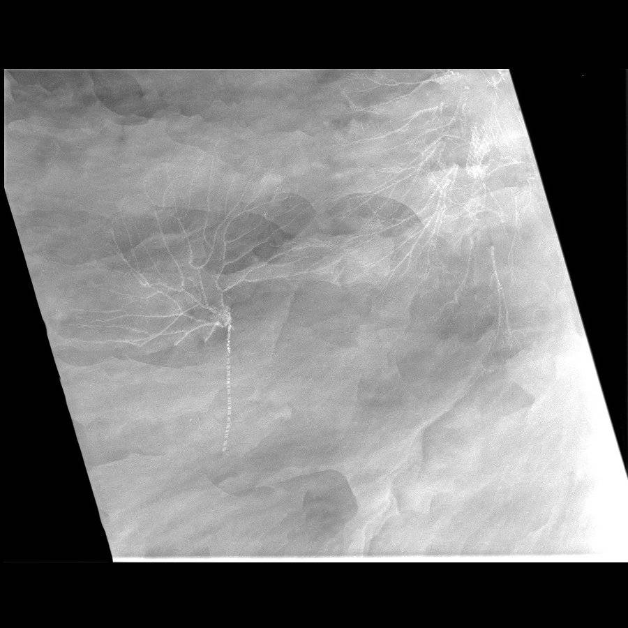 Hapalocrinus sp., Gastrocrinus giganteus; Bundenbach